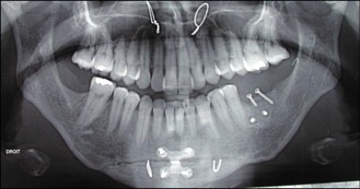 indication-greffe-osseuse-apposition